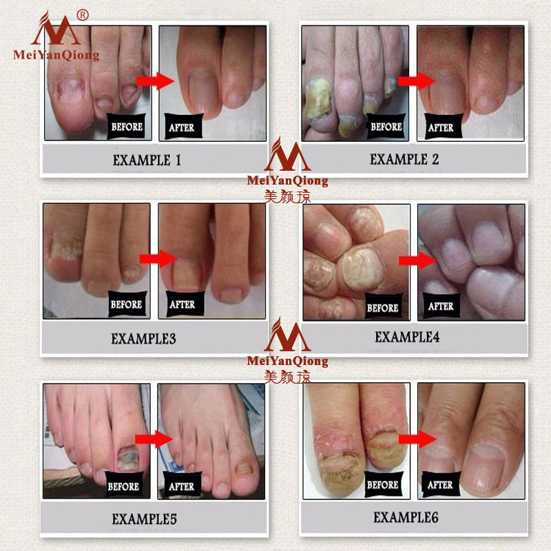 Fungal Removal Nail Treatment Care & Anti Infection Paronychia Onychomycosis