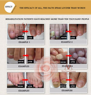 Fungal Removal Nail Treatment Care & Anti Infection Paronychia Onychomycosis