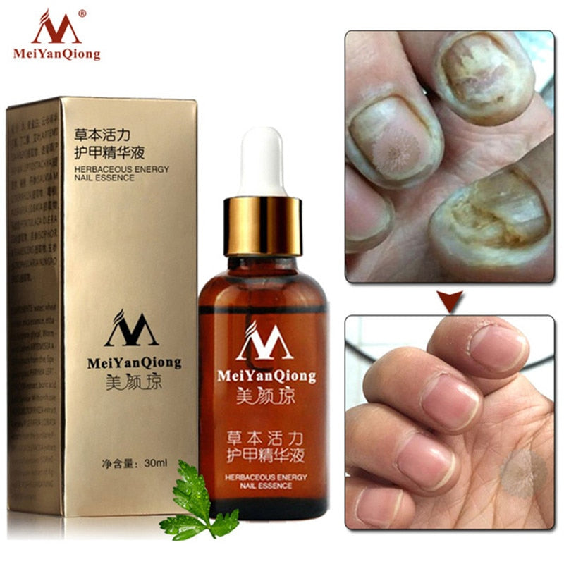 Fungal Removal Nail Treatment Care & Anti Infection Paronychia Onychomycosis